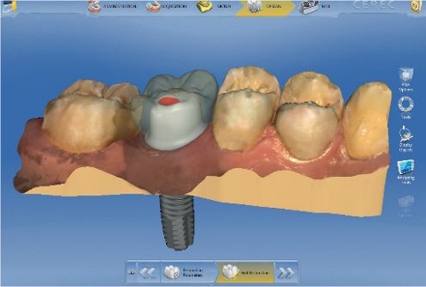 1日で治療完了「デジタル歯科」しかも割安